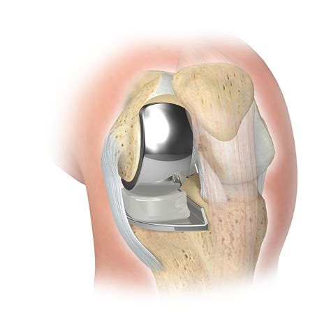 Zimmer Biomet Knee Replacement