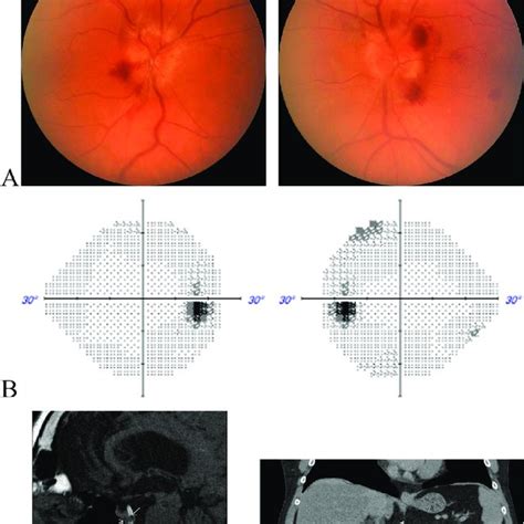 A Fundus Photographs Show Bilateral Grade Ii Optic Disc Edema And