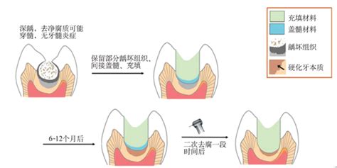 Indirect Pulp Therapy For Deciduous Teeth With Deep Caries Lesions