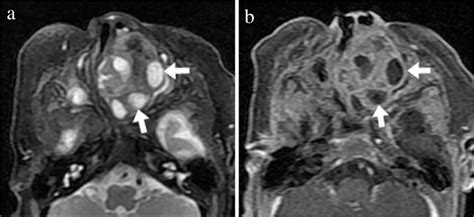 Mr Imaging Of Sinonasal Cavity A An Axial T Weighted Mri Showed A