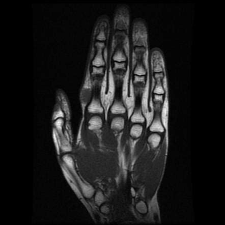 Tenosynovial Giant Cell Tumor Index Finger Image Radiopaedia Org