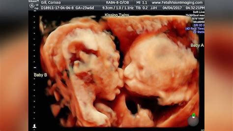 Pregnant Moms Ultrasound Reveals Twin Babies Kissing Inside Womb