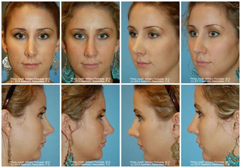 Saddle Nose Before And After Photo Gallery Nose Surgery Photos