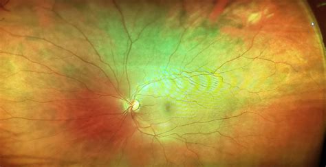 Optomap Retinal Eye Exam Springfield And Wayne Nj Garden State Eye