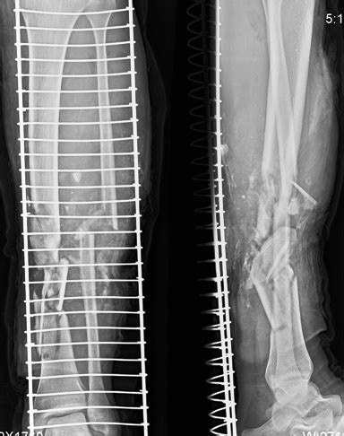 Radiographs of Tibia Fibula Fracture | Bone and Spine