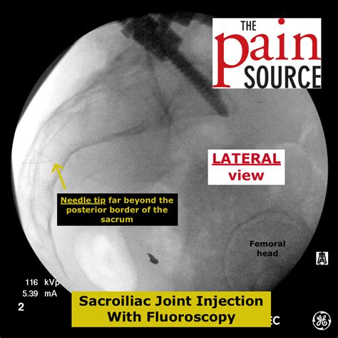 Sacroiliac Joint Injection With Fluoroscopy Technique And Tips The Pain Source Makes