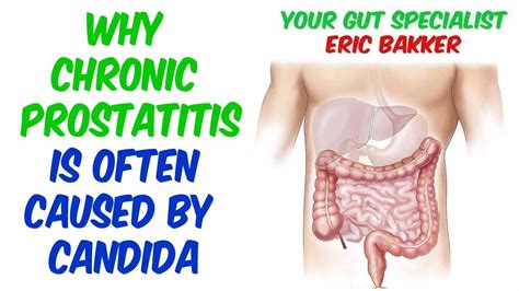 chronic prostatitis is often caused by candida youtube