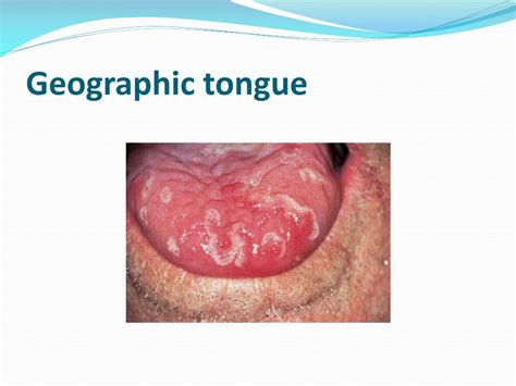 Ppt Tongue Disorders Powerpoint Presentation Free Download Id1150997