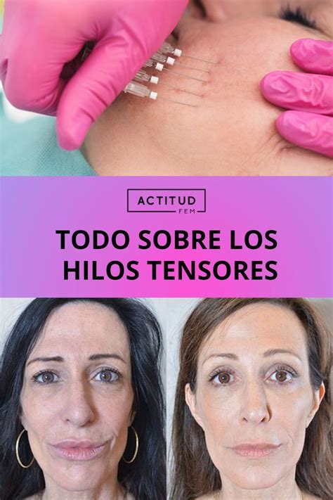 Hilos Tensores Qué Son Cómo Funcionan Y Todo Lo Que Hay Que Saber De