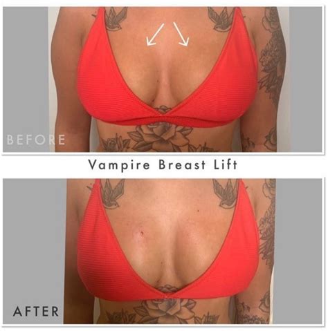 VAMPIRE BREAST LIFT The Face Factory