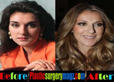Celine Dion Plastic Surgery Before And After Pictures Plastic Surgery Magazine