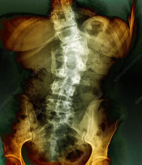 Broken Back X Ray Stock Image M3301308 Science Photo Library