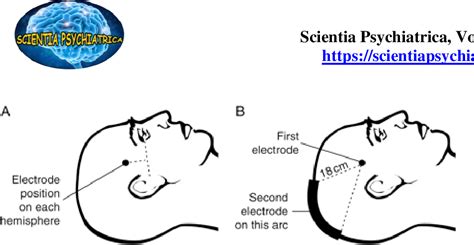 Figure 1 From Evidence Based Electroconvulsive Therapy For Major