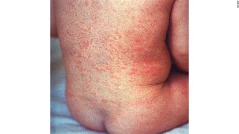 Rubella Is Eliminated In Australia As The Disease Prompts A Travel