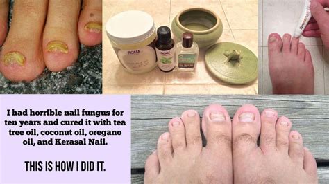Essential Oils For Treating Fungal Infections Coconut Oil Nails