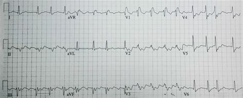 Twelve Lead Ecg Showing Atrial Flutter With 21 And 31 Download