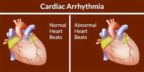 What Is Cardiac Arrhythmia Heart Rhythm Disorder Cardiac Arrhythmia