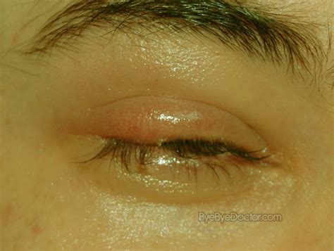 Stye Eye Symptoms Causes Pictures Treatment Prevention Symptoms