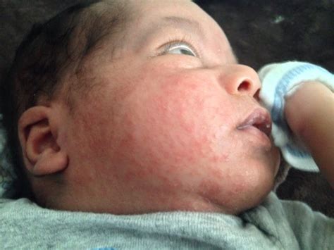 Newborn Rash On Face