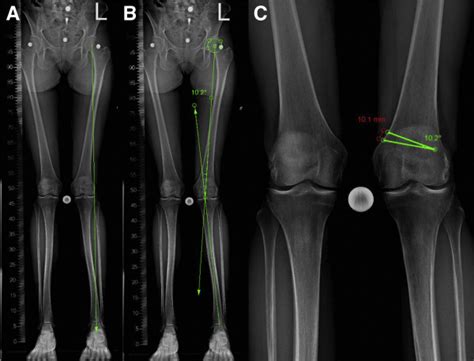 Medial Biplanar Closing Wedge Distal Femoral Osteotomy Using An