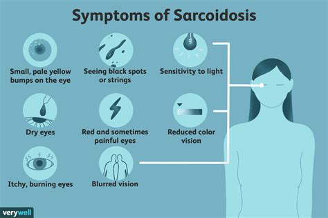 Ocular Sarcoidosis Symptoms Causes And Diagnosis