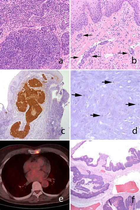 Hpv Positive Squamous Cell Carcinoma Of The Oropharynx Are We