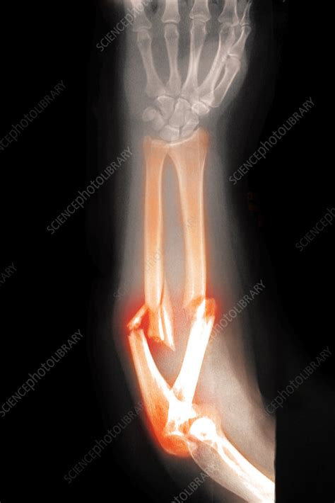 Angulated And Comminuted Fracture Stock Image C0272659 Science