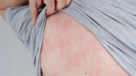 Unexpected Complications Of Severe Eczema