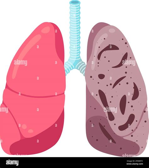 Lung Tissue With Pneumonia Stock Vector Images Alamy