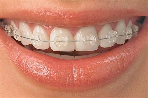 Invisible Braces Birmingham Specialist Teeth Straightening
