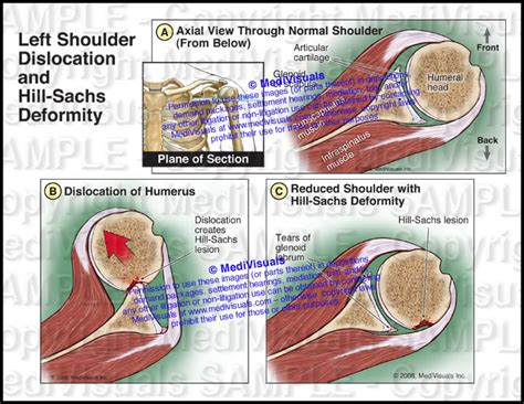 Left Shoulder Dislocation And Hill Sachs Deformity Medivisuals Inc