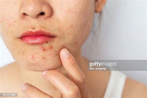 Inflamed Skin Photos And Premium High Res Pictures Getty Images