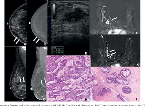 Figure 5 From Comparison Of Contrast Enhanced Spectral Mammography And