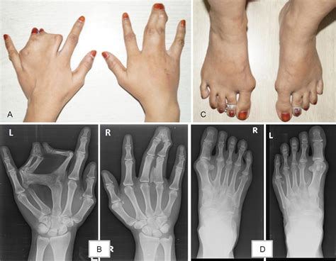 Occurrence Of Synpolydactyly And Omphalocele In A Fetus With A Hoxd