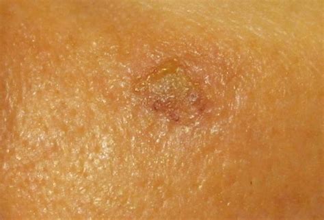 Is skin bleaching using hydrogen peroxide possible? Skin Cancer Forum - Hydrogen Peroxide 3%