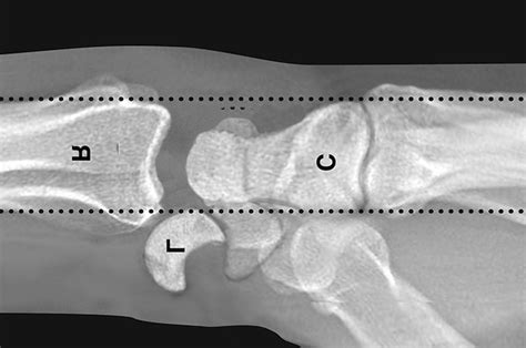 Dislocation Wrist Lunate Hand Surgery Source