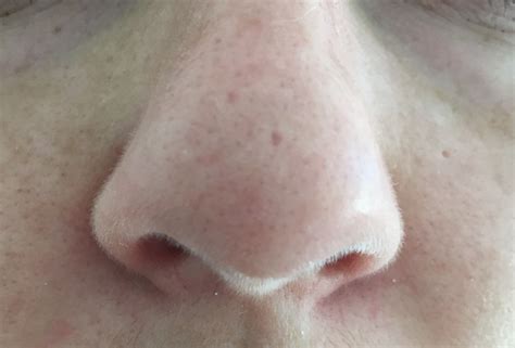 Needling On Tip Of Nose Scar Treatments Forum