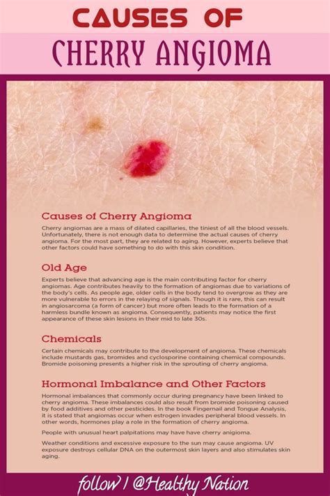 Causes Of Cherry Angioma Cherry Angioma Home Remedies Natural Remedies Body Cells Franciscan