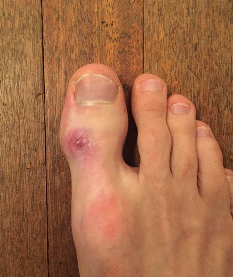 Bump On Big Toe 1 Year Update And Related Thoughts Climbing