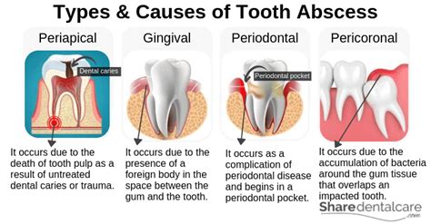 Tooth Abscess Treatment At Home And Dental Office Share Dental Care