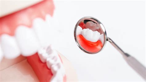 Zahnfleischr Ckgang Ursachen Symptome Behandlung