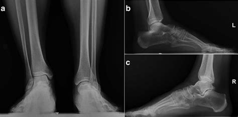 Anteroposterior Radiograph Of Both Ankles A And Lateral Radiographs