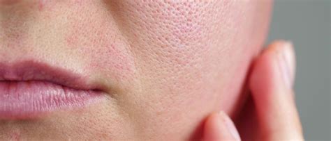 Rosacea Ursachen Behandlung And Hautpflege • Hautbewusst