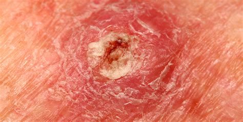 Basal Cell Carcinoma Reddit Basal Cell Carcinoma Removal Treatment