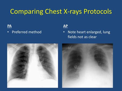 Ppt Basics Of Chest X Ray Powerpoint Presentation Free Download Id