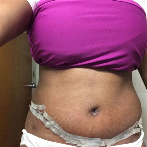 3 Weeks From Having My Tummy Tuck Navel Healing Well Stomach Is