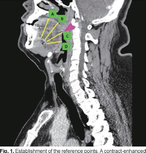 Figure 1 From Defining Safety Space For Functional Tongue Surgery In Korean Male Obstructive