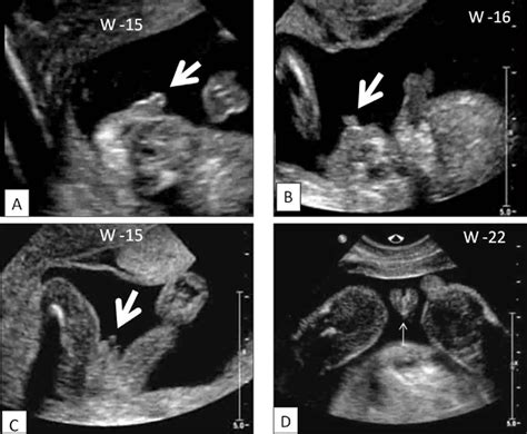 Fetal Transient Clitoromegaly And Transient Hypertrophy Of The Labia