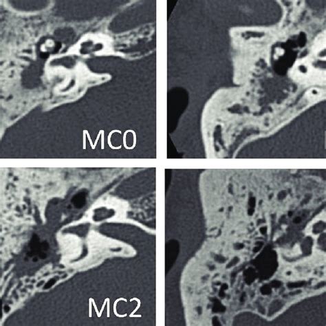 The Eaonojos Staging System For Pars Flaccida Cholesteatoma Attic