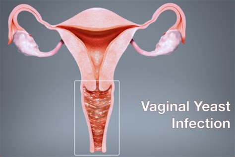 Vaginal Candidiasis And The Most Common Yeast Infection In Women